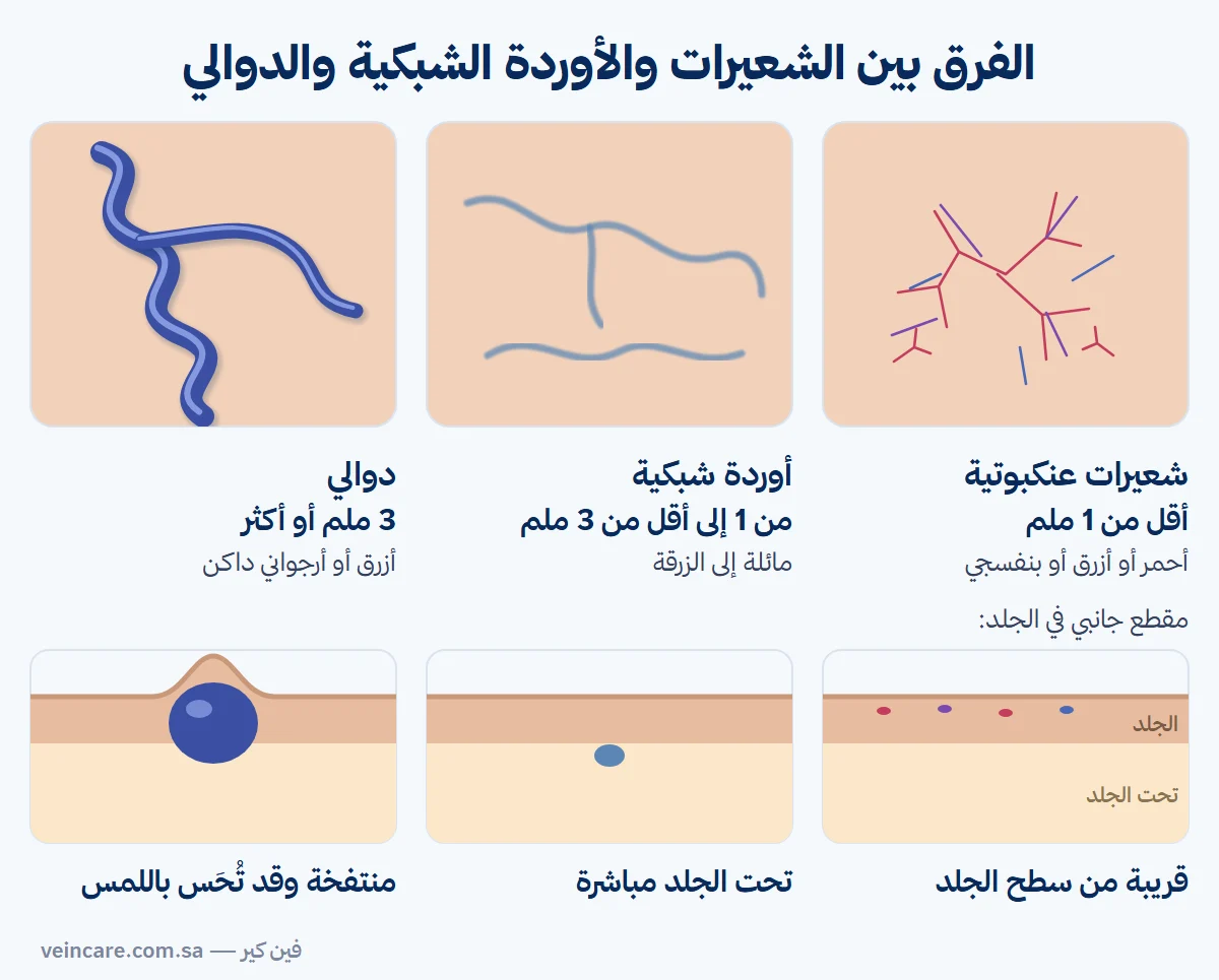 رسم توضيحي يقارن الشعيرات العنكبوتية والأوردة الشبكية والدوالي في الشكل والحجم واللون والعمق تحت الجلد